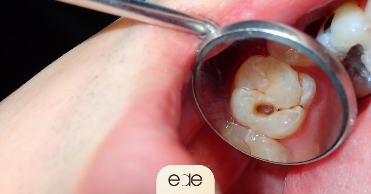 Dentist examining a decayed tooth with a cavity that may cause pain when eating sweets