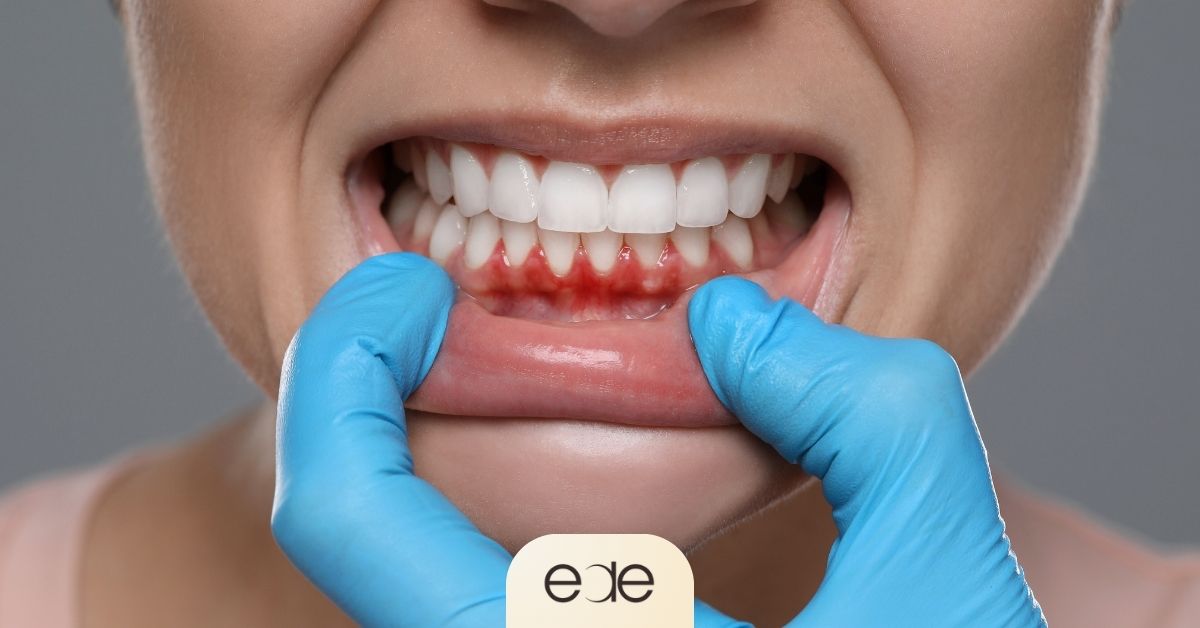 Close-up dental image demonstrating gum recession along the lower front teeth and gumline
