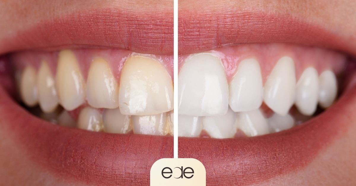 Before-and-after comparison of a smile showing age-related yellow teeth alongside a brighter whiter smile, illustrating common cosmetic treatment options for improving tooth discoloration