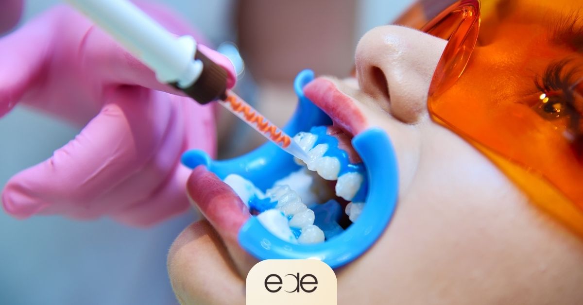 Application of bleaching agent to teeth during a clinical whitening session, illustrating safe and effective dental bleaching techniques.