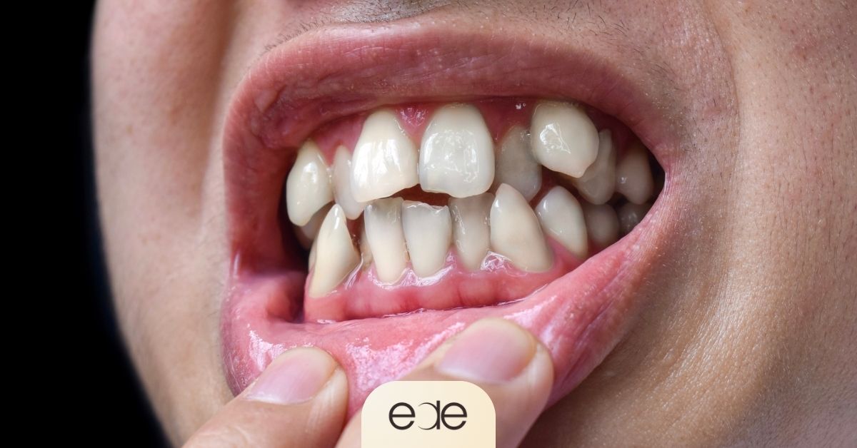Genetic tooth alignment issues associated with gum recession and uneven gumline exposure