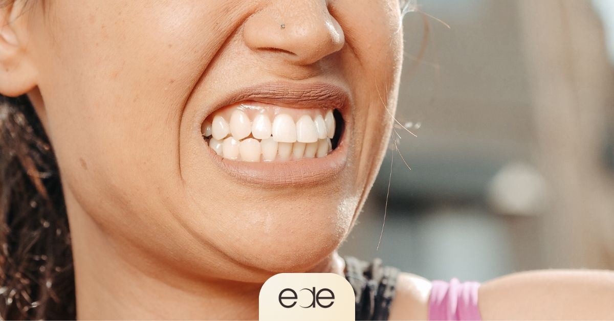 Woman clenching her teeth due to teeth grinding.