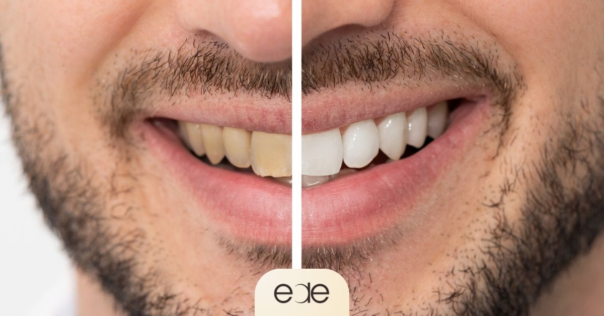 A before-and-after comparison of a man's smile, showing yellowed teeth on the left and bright white teeth on the right after a whitening treatment.