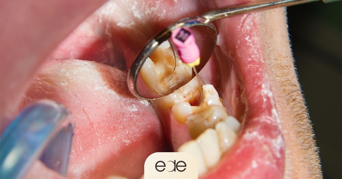 Dentist performing root canal treatment to eliminate a tooth infection