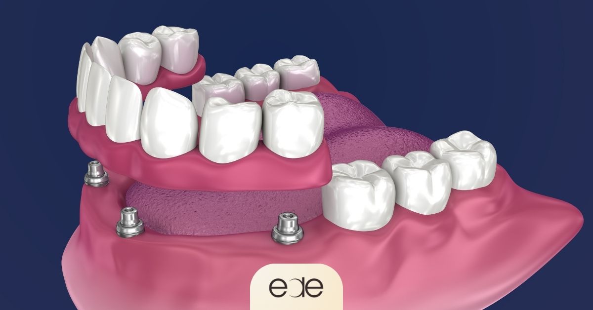 3D illustration of overdentures supported by dental implants