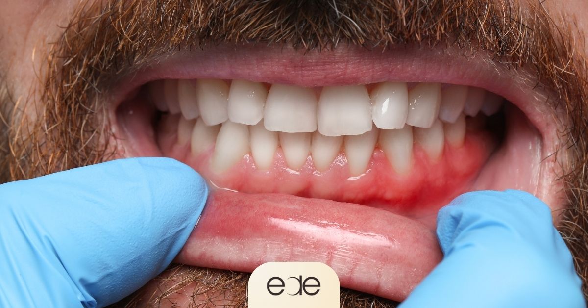 Close-up dental image showing gum inflammation and recession caused by periodontal disease