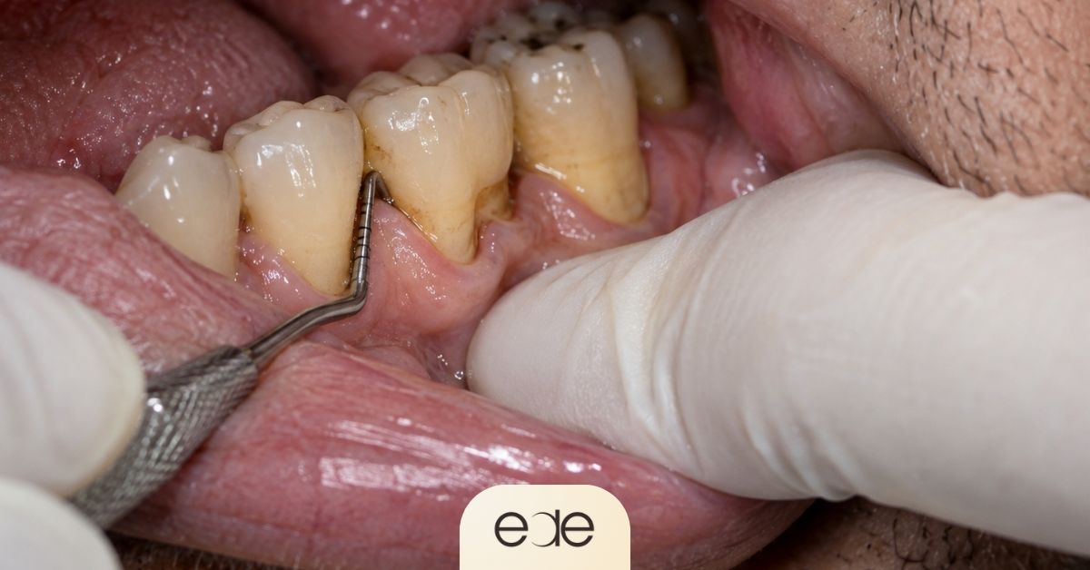 Periodontal probe measuring a deep gum pocket around teeth with advanced Stage III periodontitis.
