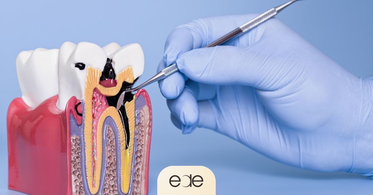 Cross-sectional tooth model showing advanced decay reaching the dental pulp, where significant pain and infection may develop