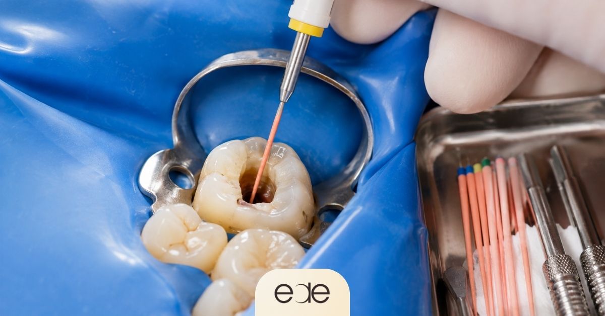 Root canal filling material being placed into a prepared molar canal under a dental dam.