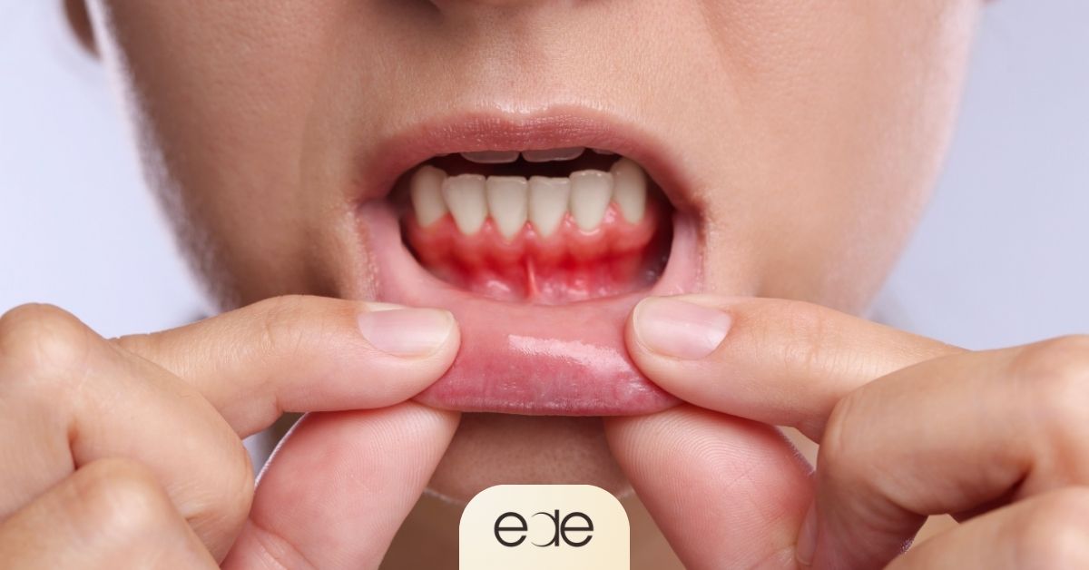 Red, swollen gums showing visible symptoms of gum disease around the lower teeth. 