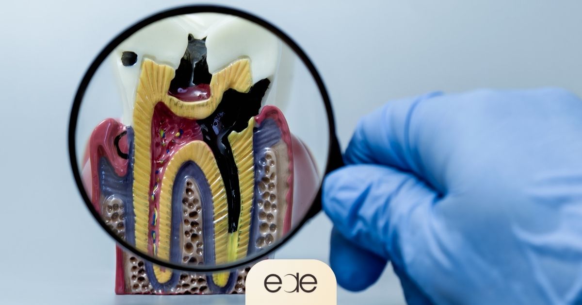 Dental model illustrating the pathway of infection from inside a tooth