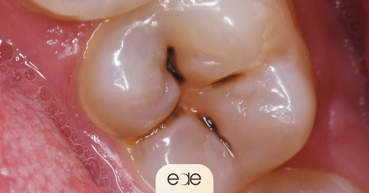 Occlusal cavity forming within the natural grooves of a molar tooth, illustrating why brushing alone may not prevent decay