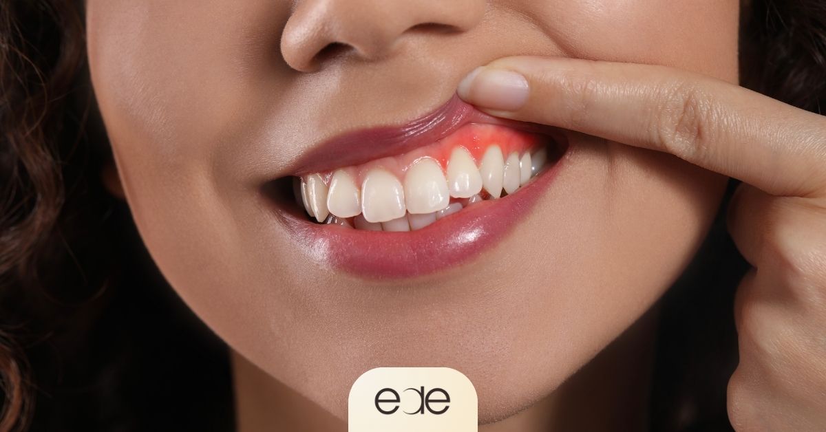 A person pointing to inflamed gums, representing the warning signs after whitening that indicate a need to stop drinking alcohol or irritating substances.