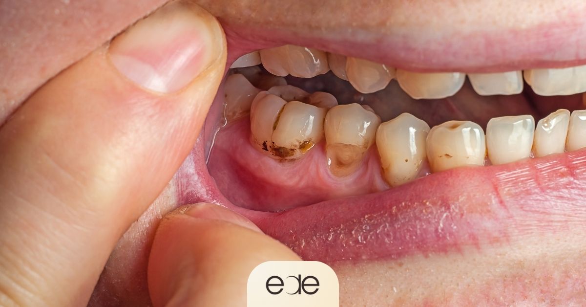 Close-up of tooth decay affecting the lower back teeth.