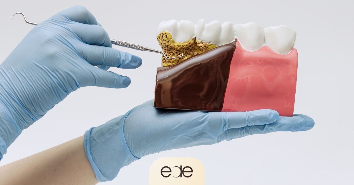Dental model showing plaque buildup around the gums, a primary cause of gum disease. 