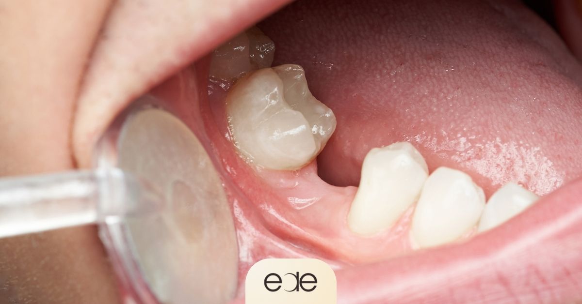 Person showing gum area after tooth loss with a visible missing tooth gap