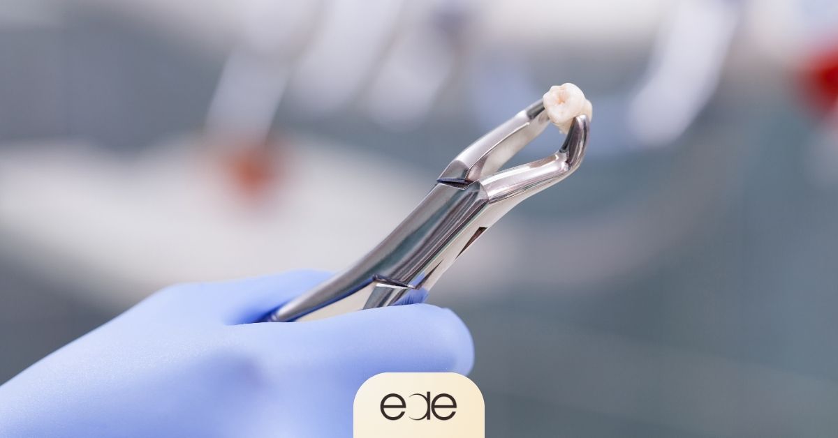 A dentist's gloved hand holding a pair of stainless steel forceps with a small, white extracted tooth, illustrating a successful dental extraction procedure.