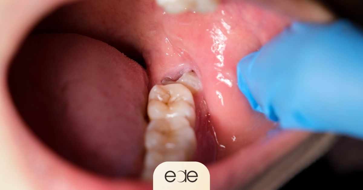 Healing extraction site after wisdom teeth removal.